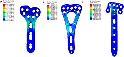 Evaluating the biomechanical performance of Ti6Al4V volar plates in patients with distal radius fractures